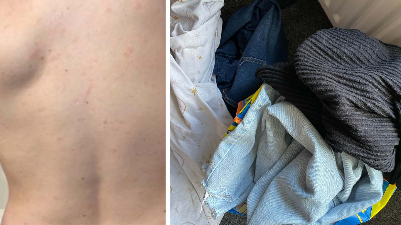 'I thought it was something people in the Victorian age got': Scabies in Lancaster